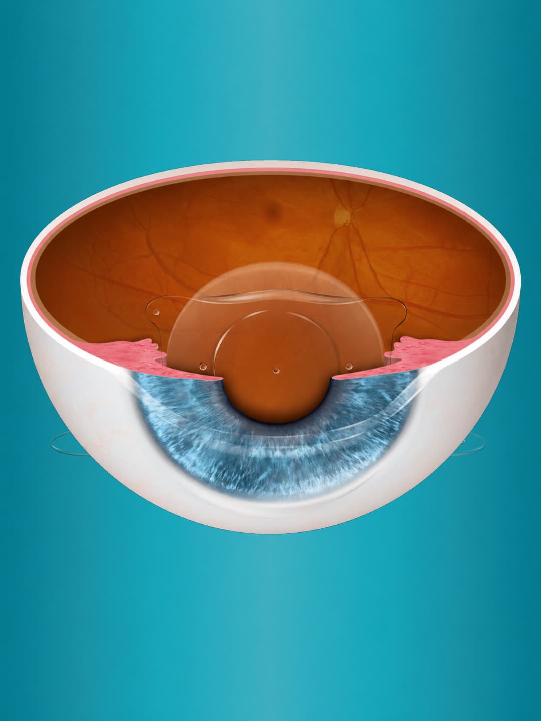 EVO ICL cutaway showing lens placement in the eye