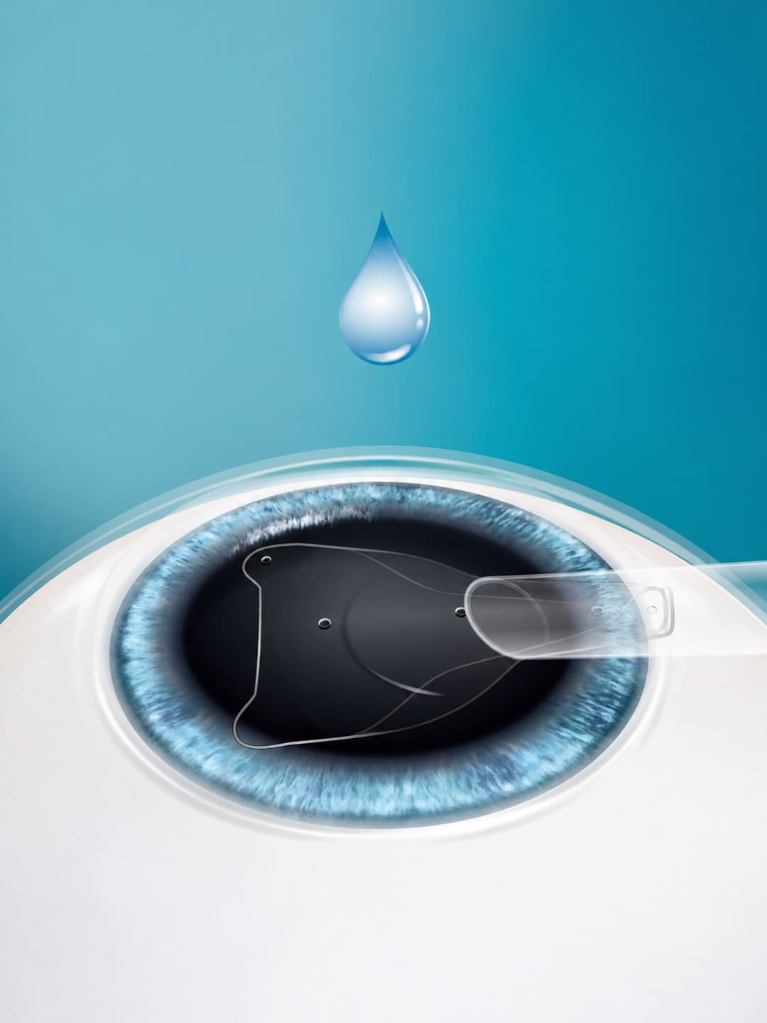 EVO ICL lens illustration