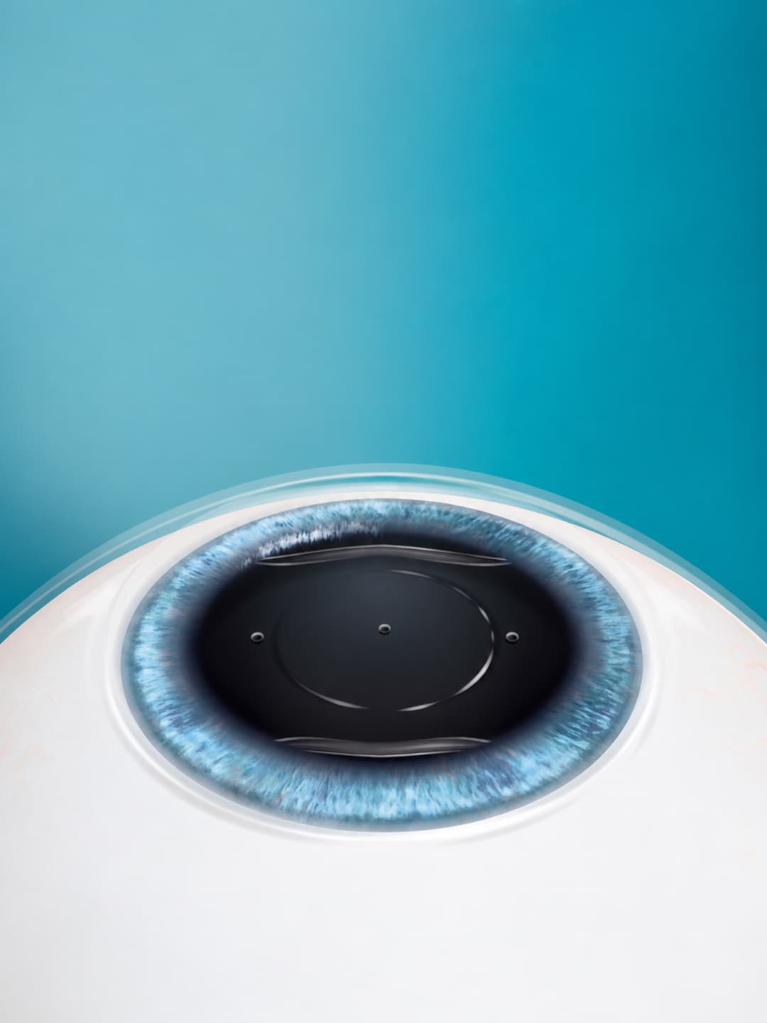 EVO ICL lens illustration