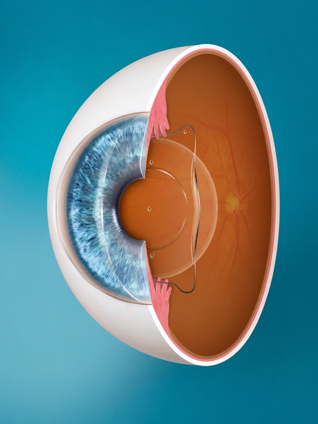 EVO ICL lens illustration