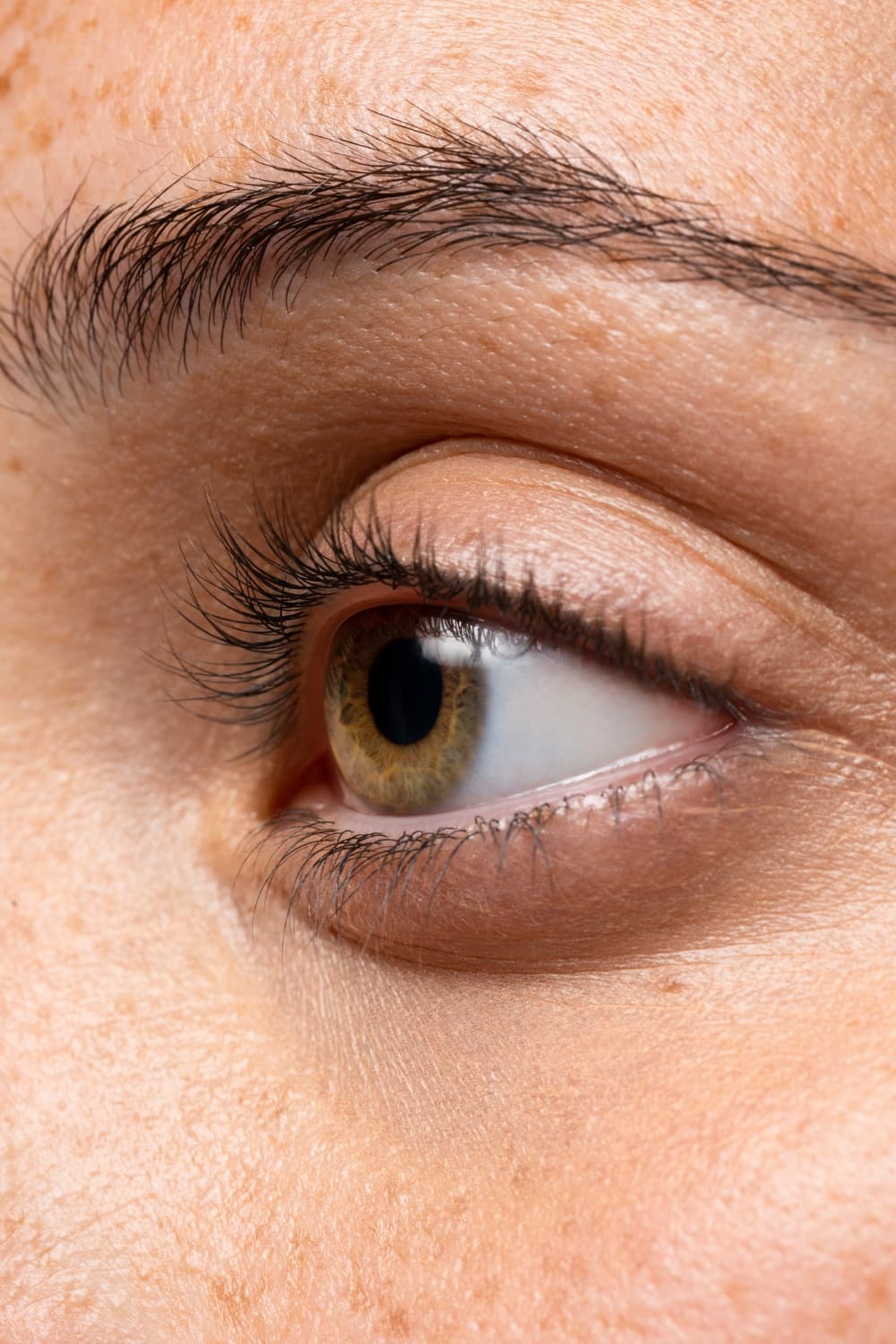 Strabismus Surgery at TheEyeDoctor clinic